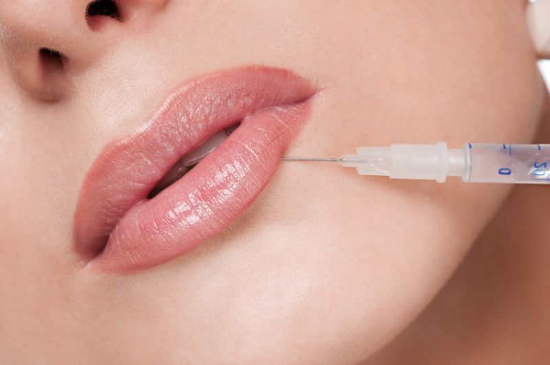 restylane. labios