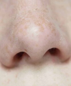 rinoplastia nariz anterior