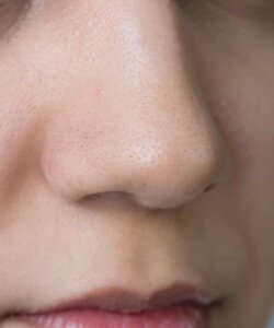 rinoplastia para armonizar