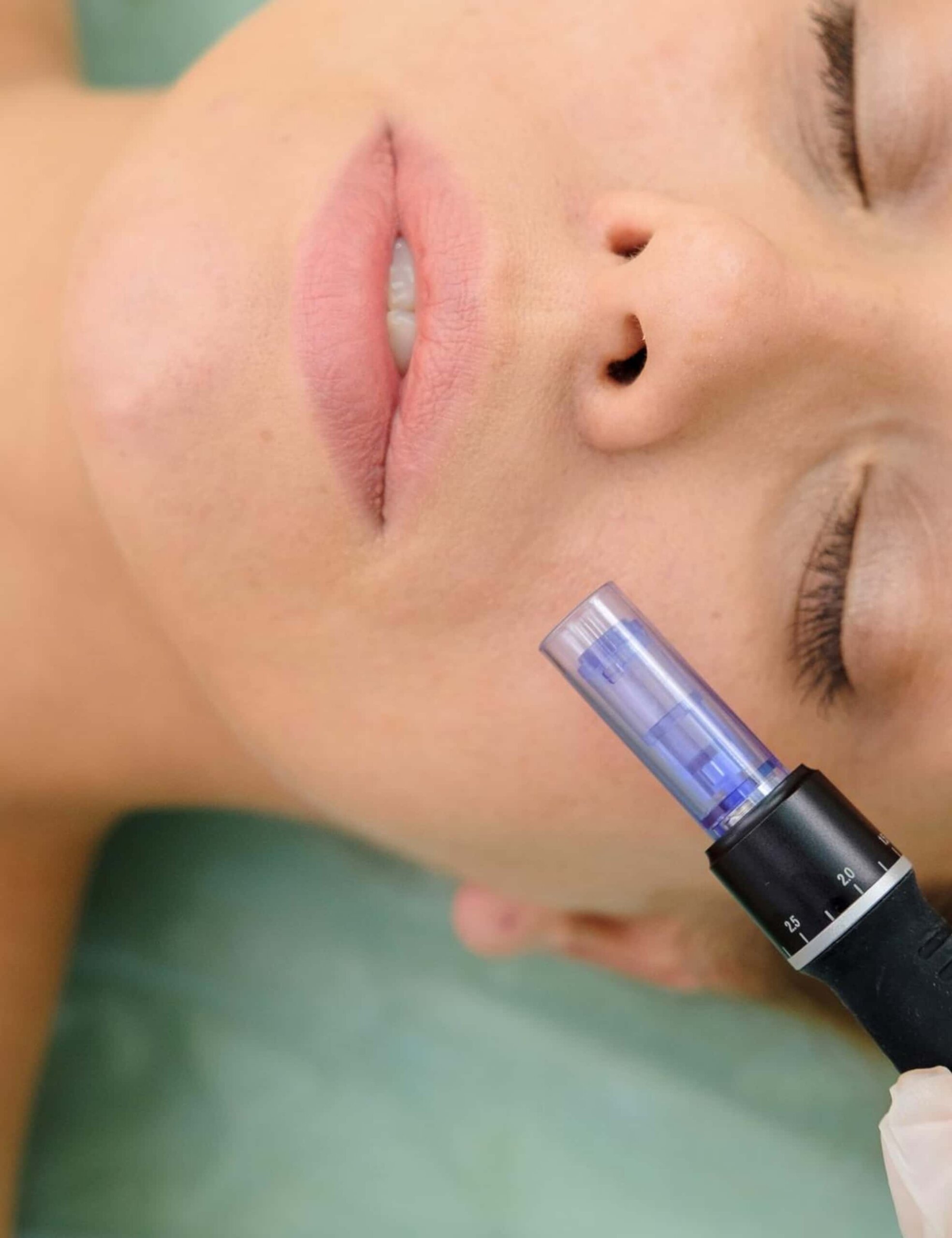 dermapen en zaragoza