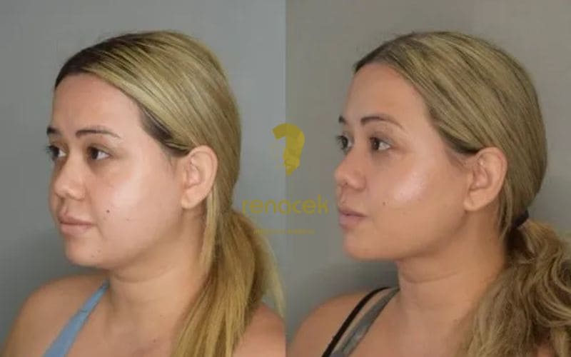 reduccion papada caso