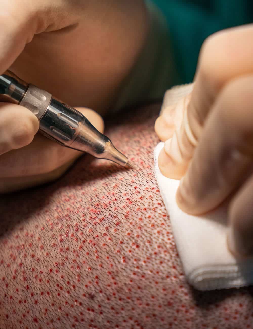 implante capilar zaragoza