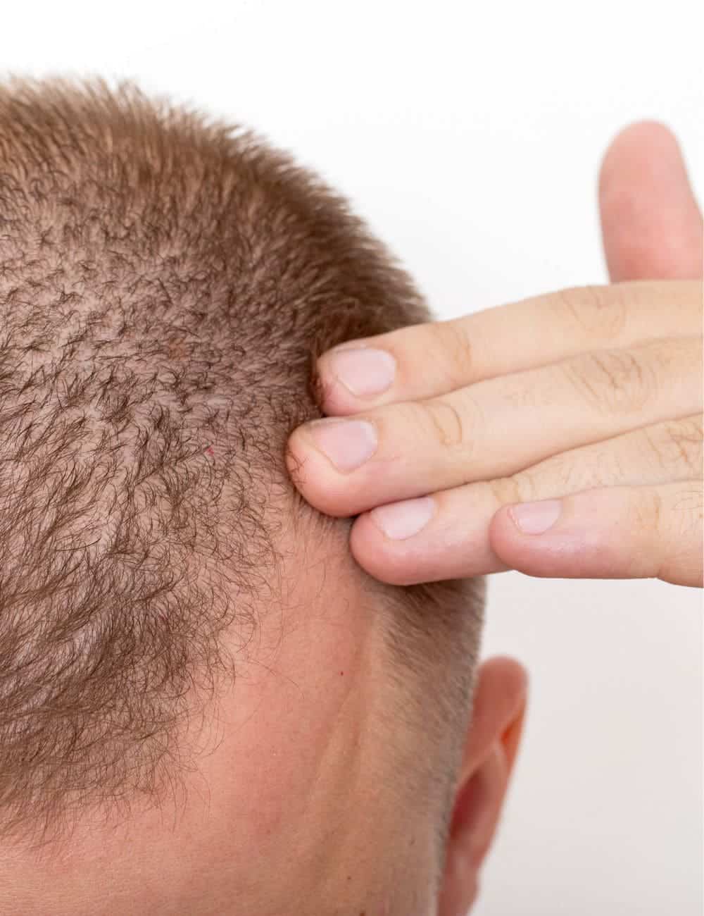 trasplante capilar zaragoza