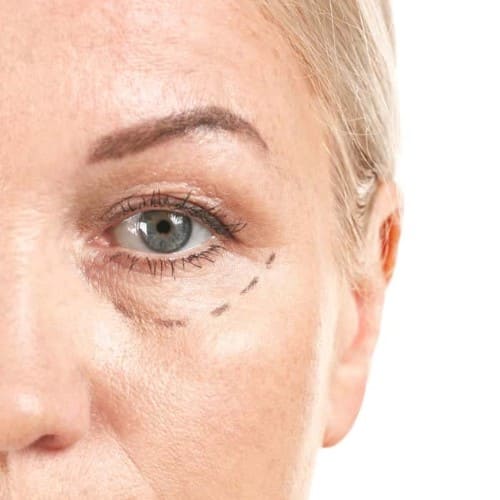 cirugía blefaroplastia zaragoza