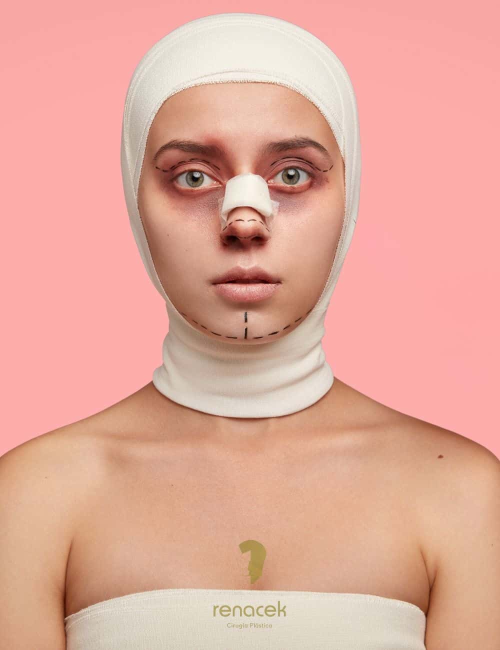 rinoplastia mal hecha, fibrosis