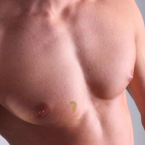 cirugia plastica de ginecomastia