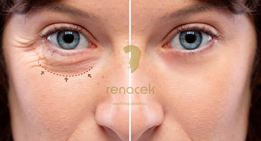 blefaroplastia barcelona