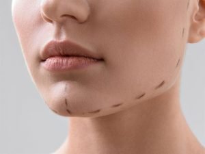 perfilado mentón zaragoza