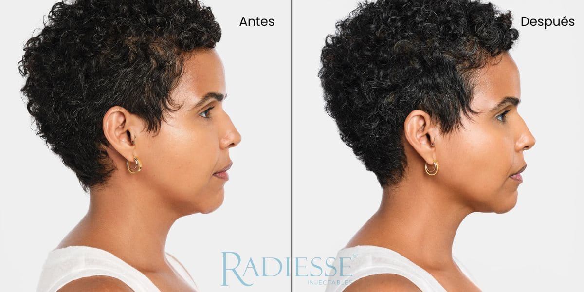 radiesse cuello antes y después