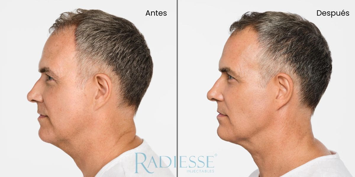 radiesse mandíbula antes y después
