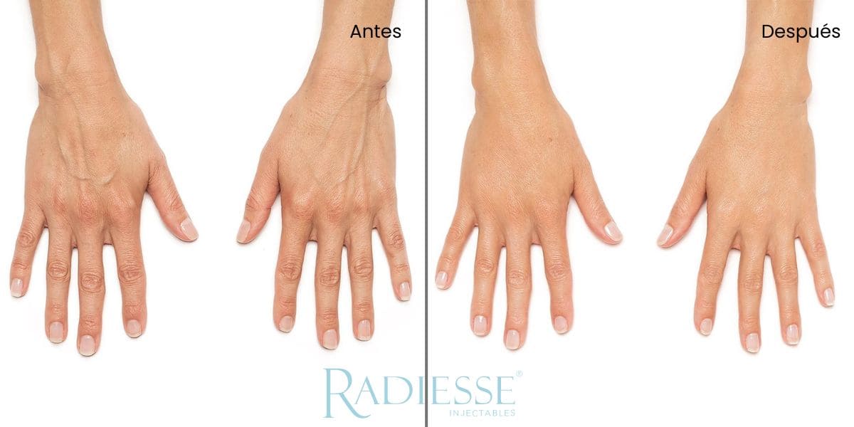 radiesse manos