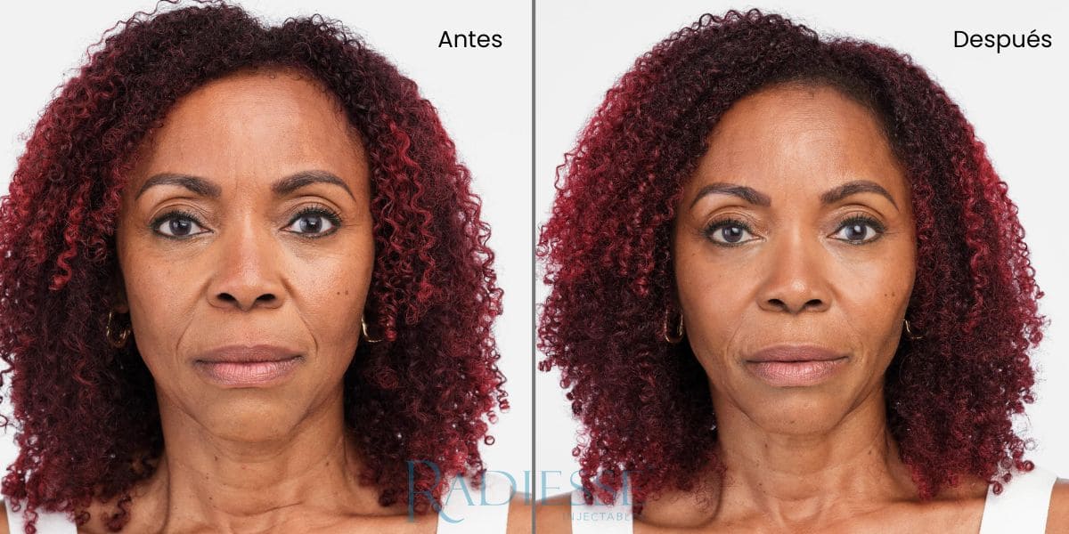 radiesse pómulos antes y después