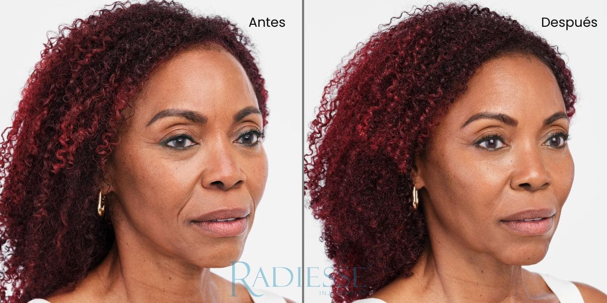 radiesse pomulos antes y despues