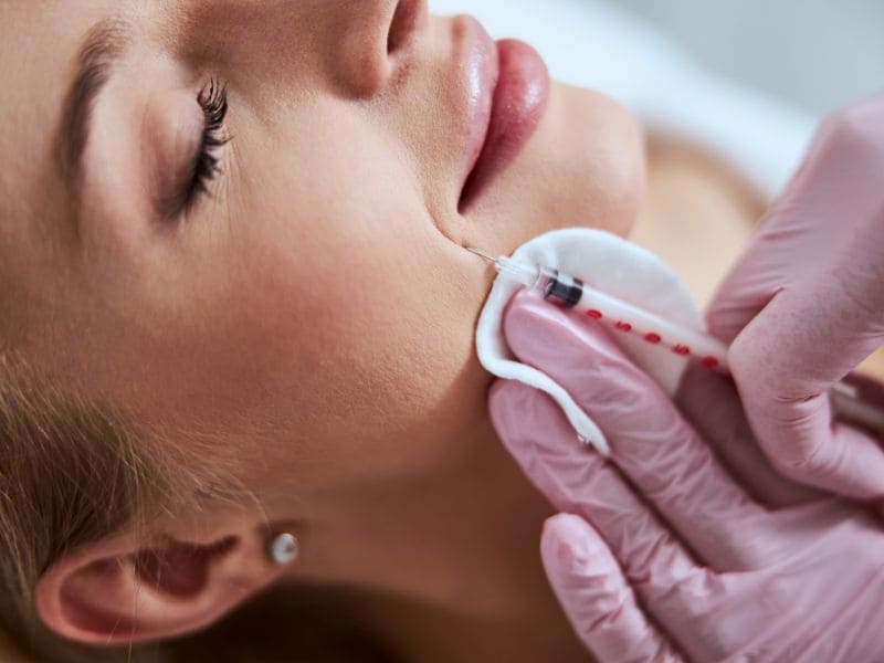 relleno surco nasogeniano acido hialuronico