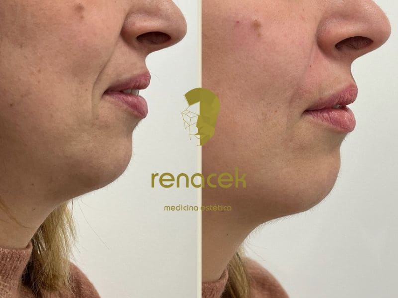 surco nasogeniano antes y despues