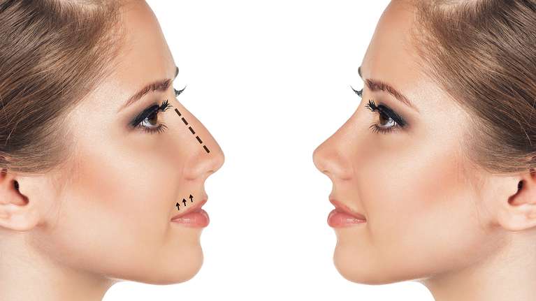 que-personas-pueden-someterse-a-una-rinomodelacion