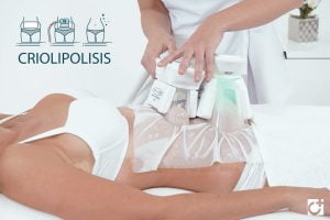 criolipolisis