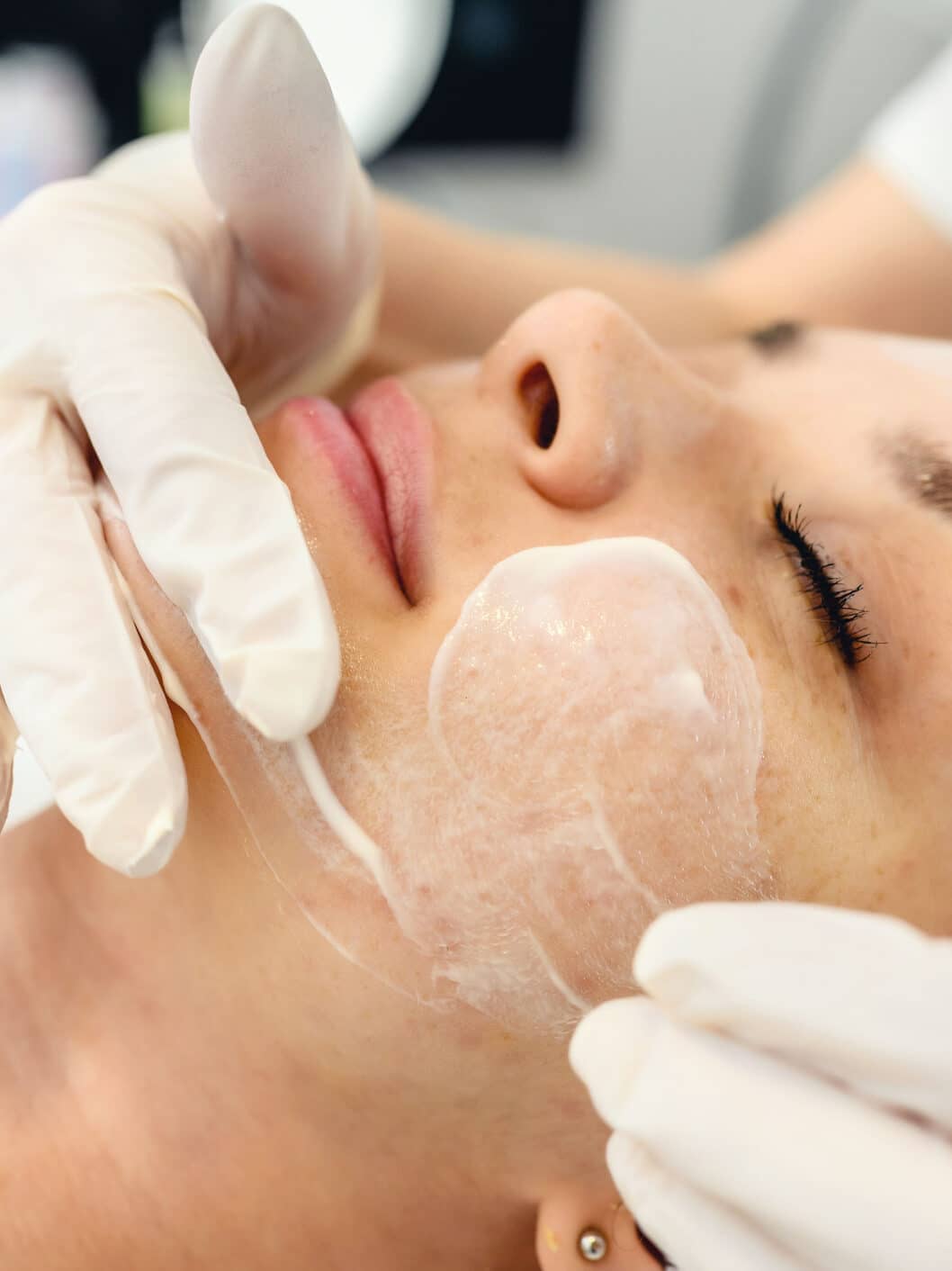 Peeling quimico antes y despues