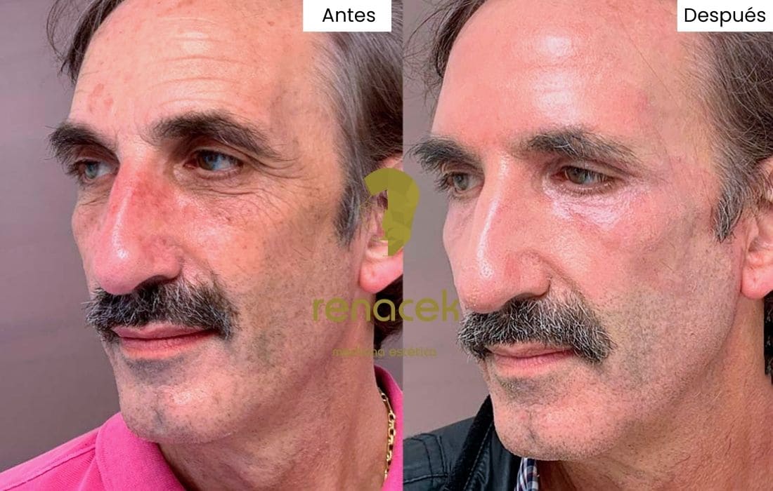 caso peeling quimico antes y después hombre
