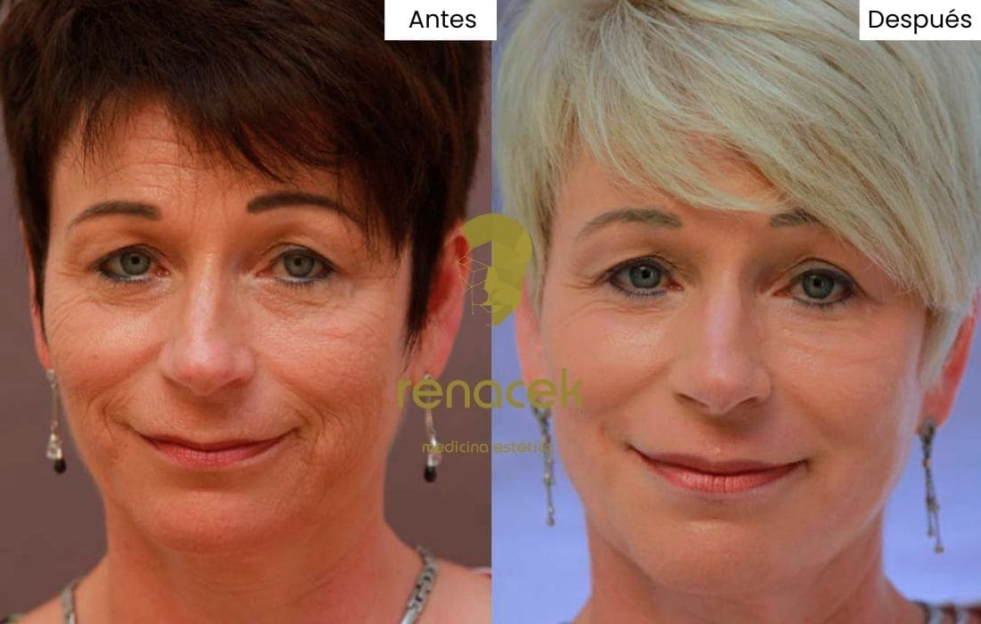 caso peeling quimico antes y después mujer