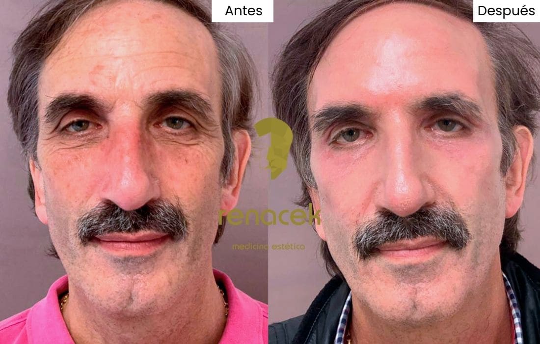 peeling quimico antes y después hombre