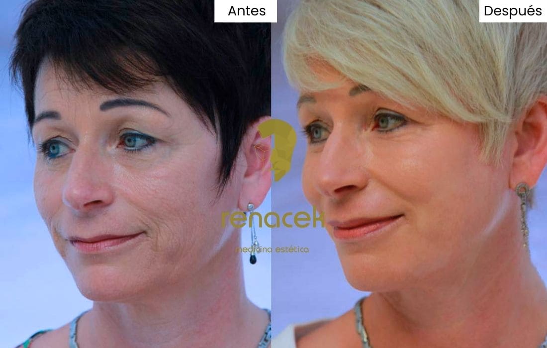 peeling quimico antes y después mujer