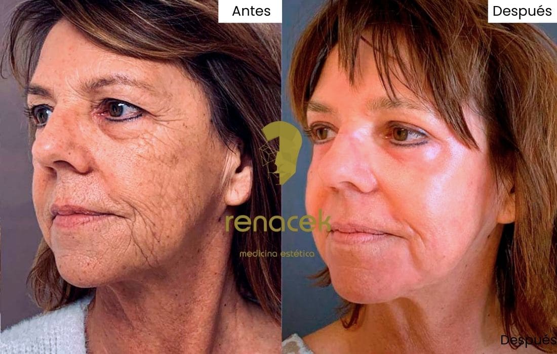 peeling quimico antes y después