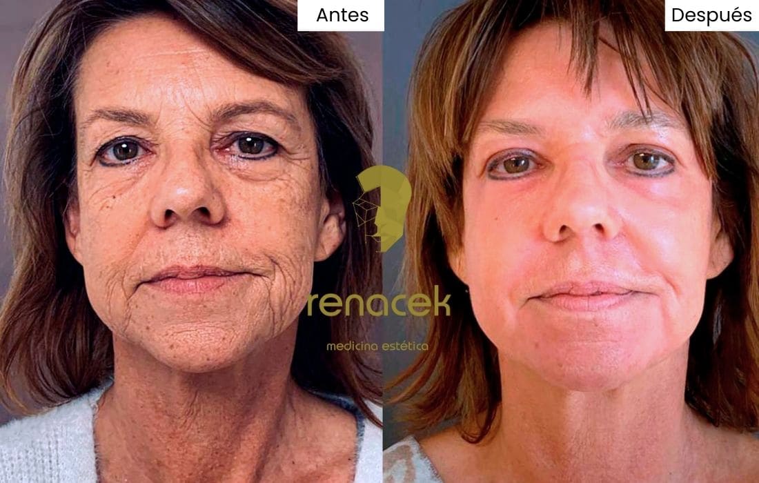 peeling quimico fotos antes y después