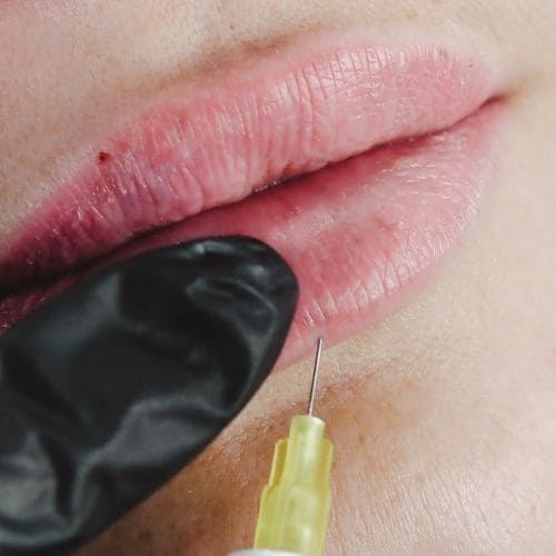 aumento de labios con ácido hialurónico
