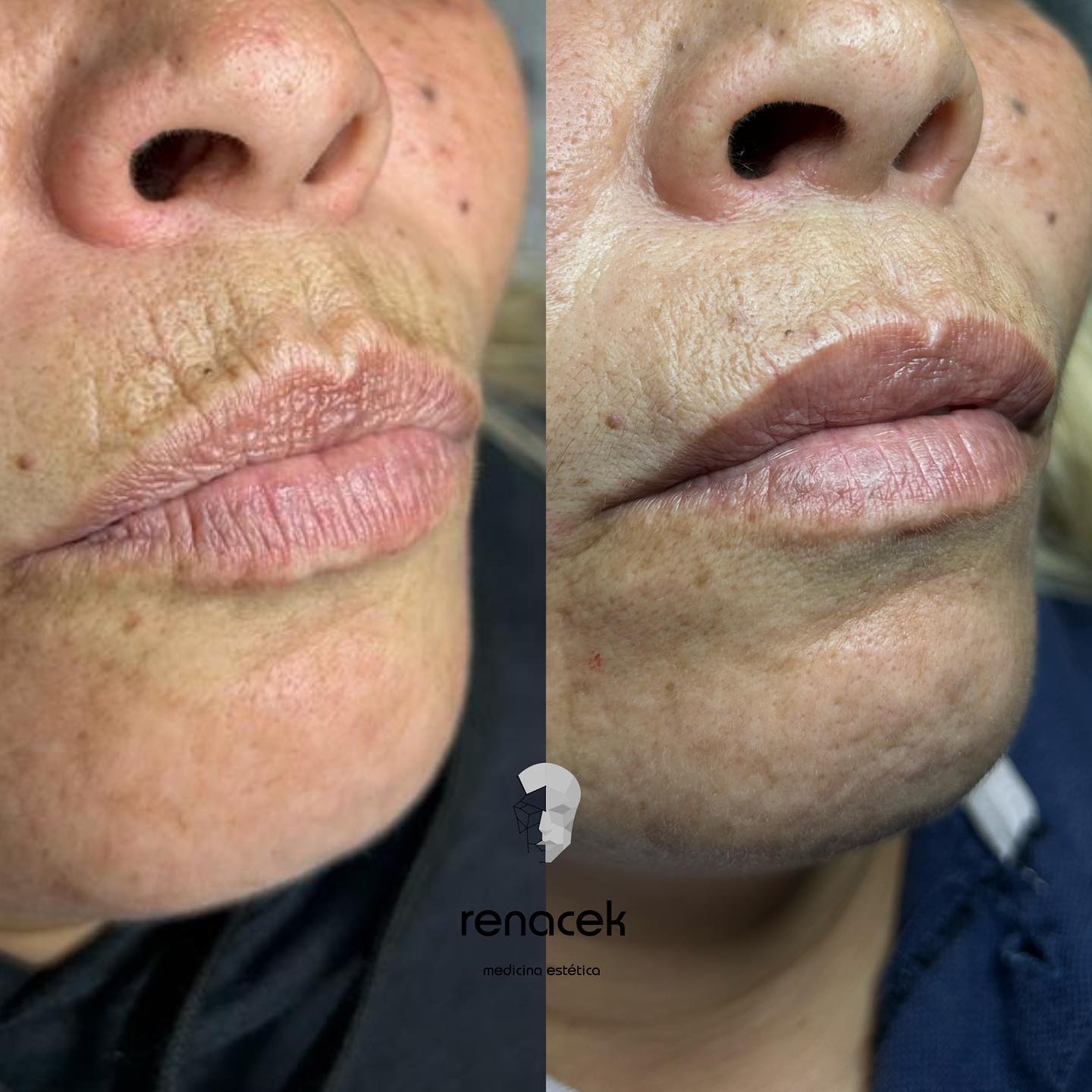 caso código de barras