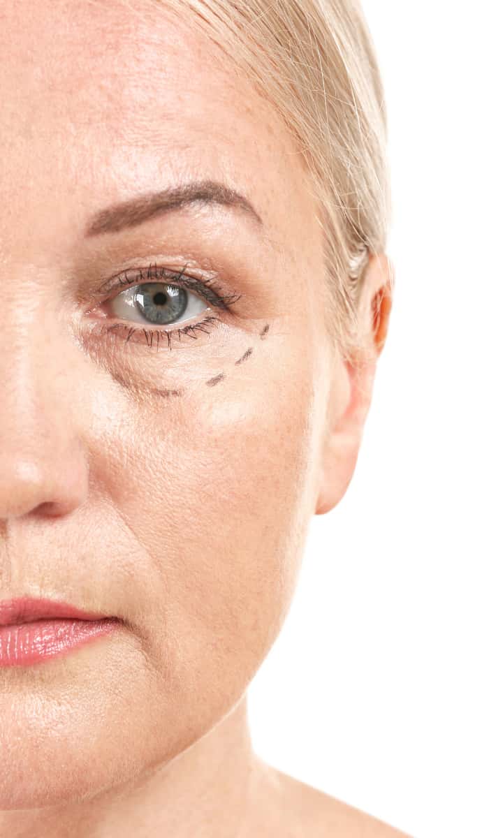 blefaroplastia en zaragoza