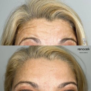 Botox antes y despues frente