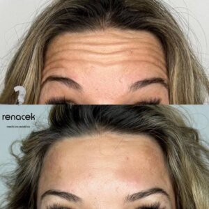 Botox en la frente antes y despues