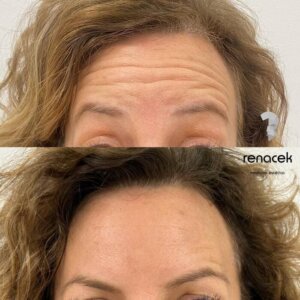 Botox frente antes y despues