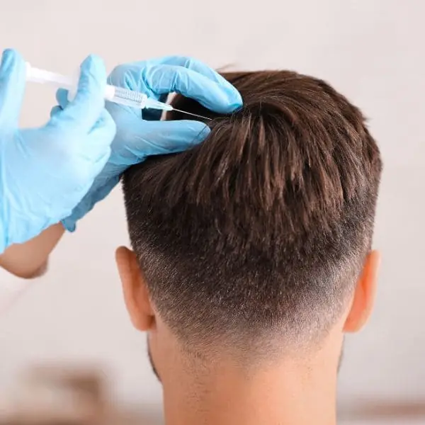 Mesoterapia capilar