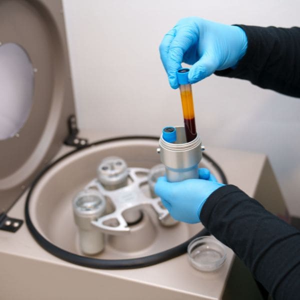 PRP Capilar y Facial