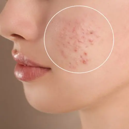 Limpieza Facial Profunda + tratamiento antiacné