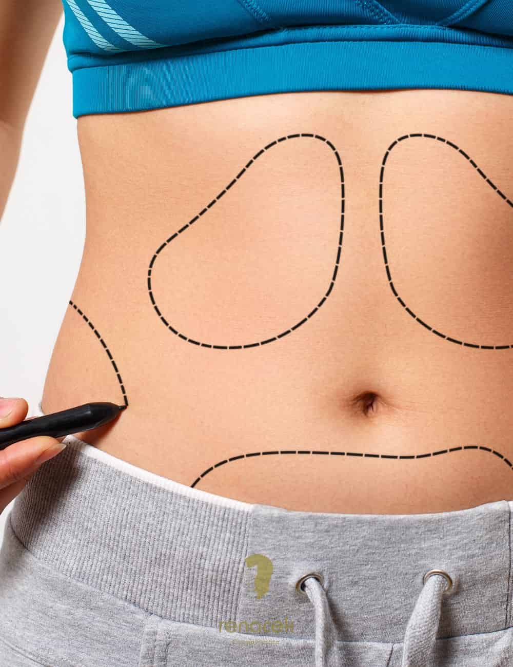 lipoescultura zaragoza