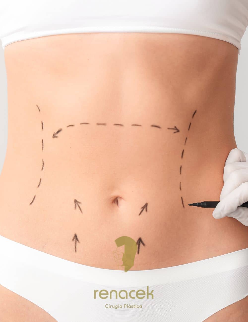 Abdominoplastia Zaragoza