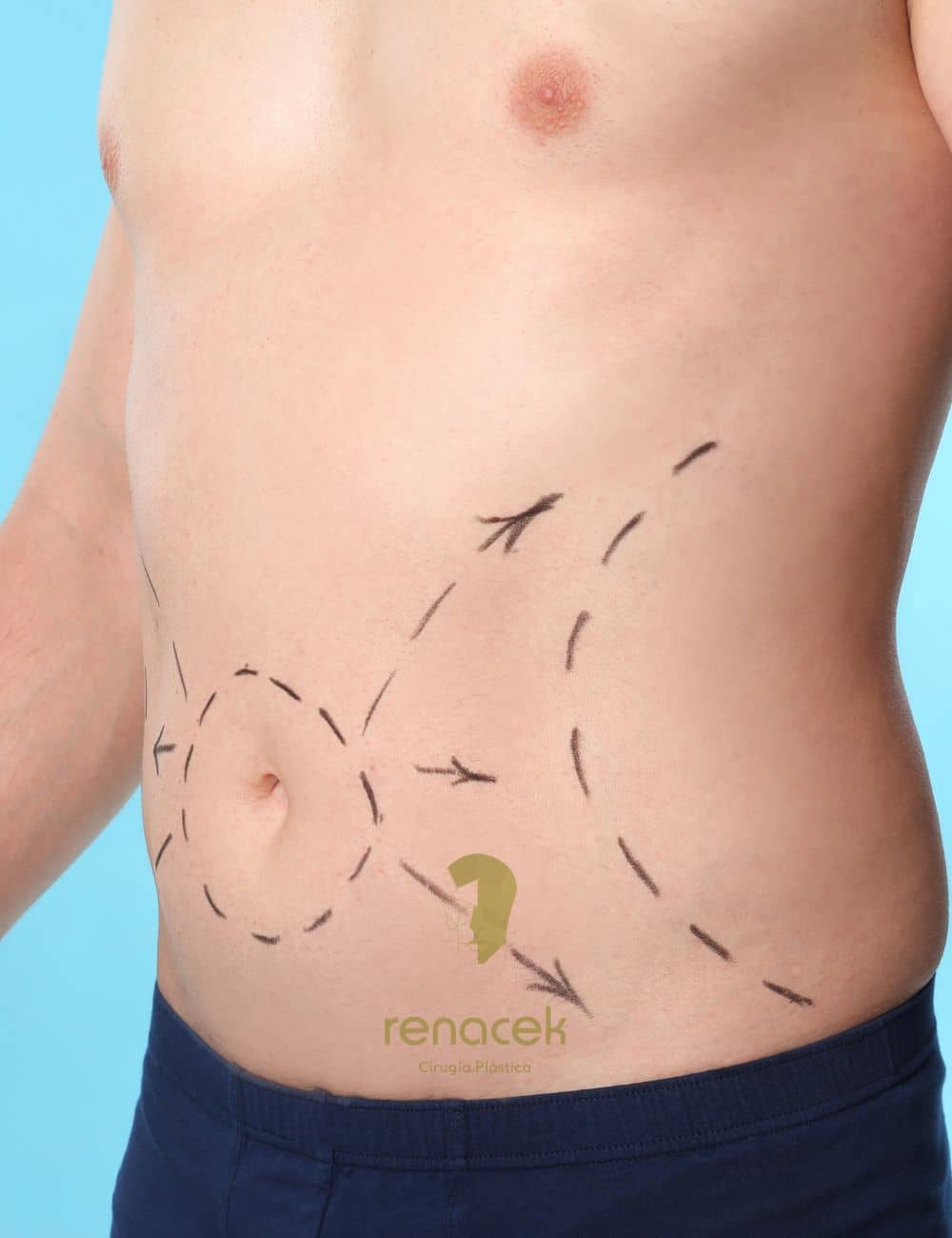 Abdominoplastia Zaragoza Precio