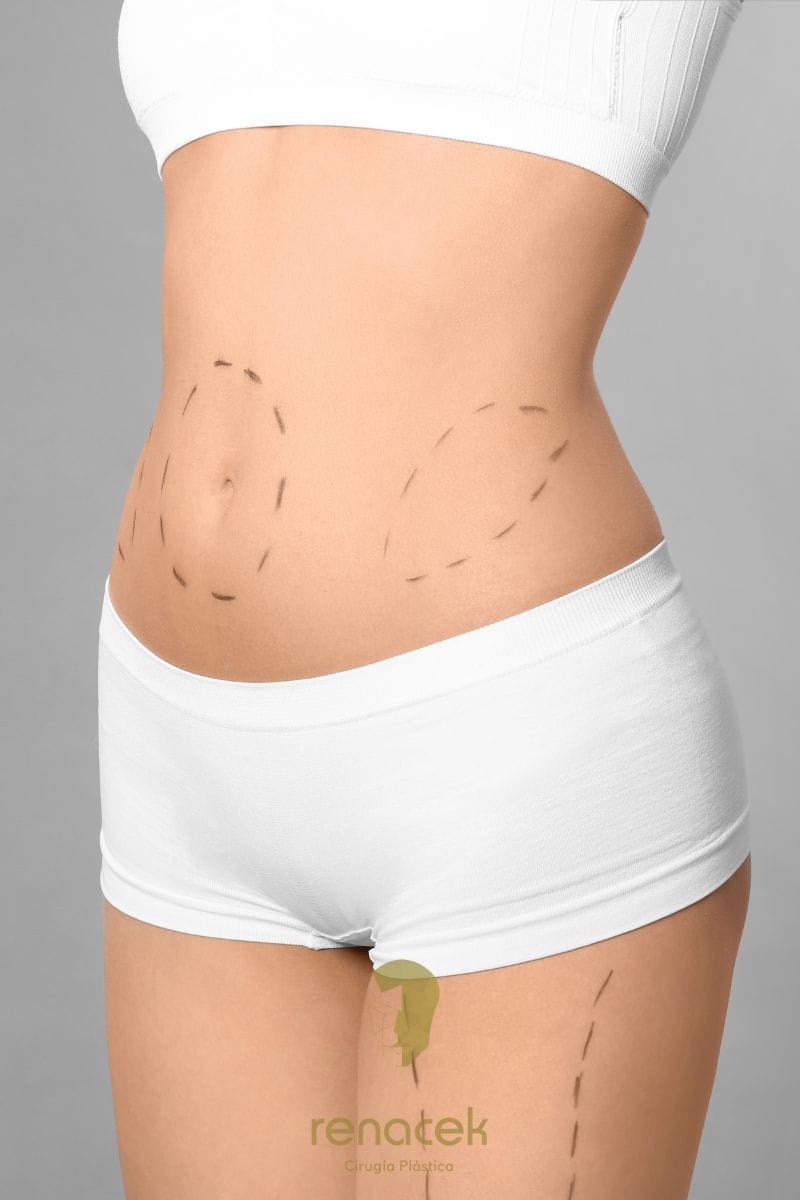 Abdominoplastia en zaragoza