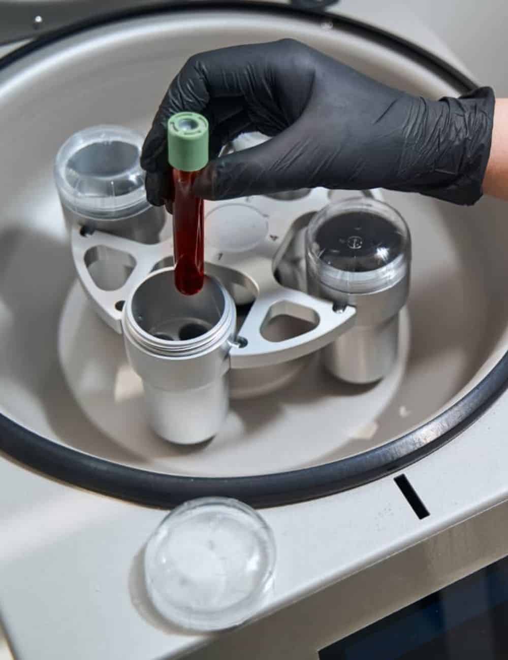 prp capilar zaragoza precio