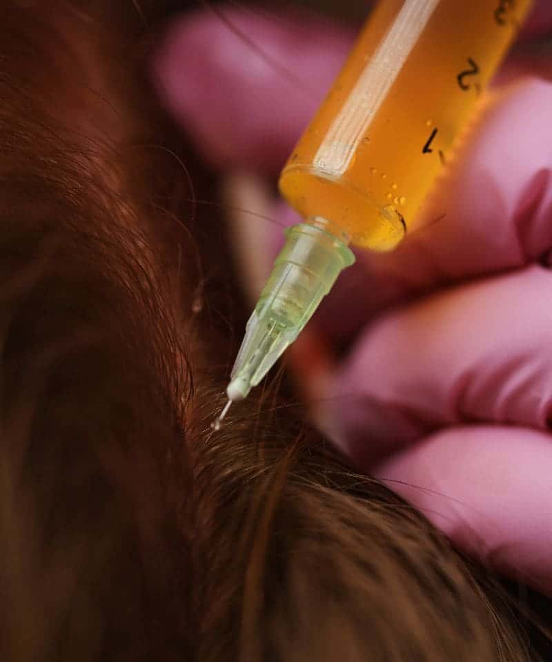 prp capilar zaragoza