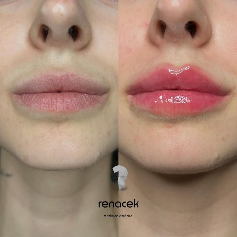 aumento de labios antes y después barcelona