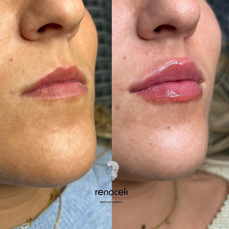 aumento de labios antes y después barcelona