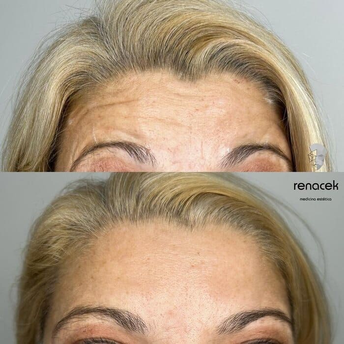 caso botox barcelona