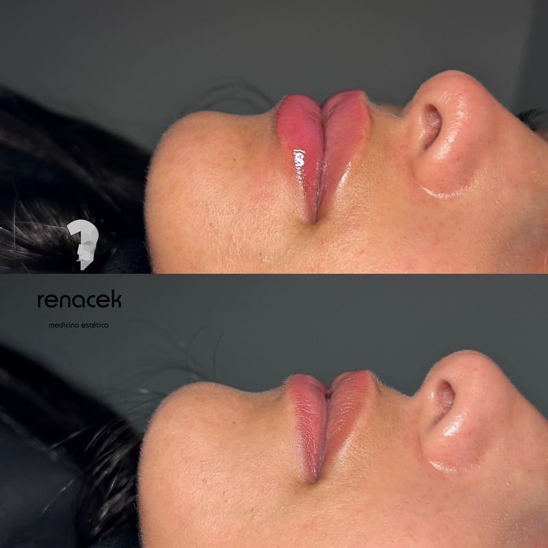 caso de aumento de labios barcelona