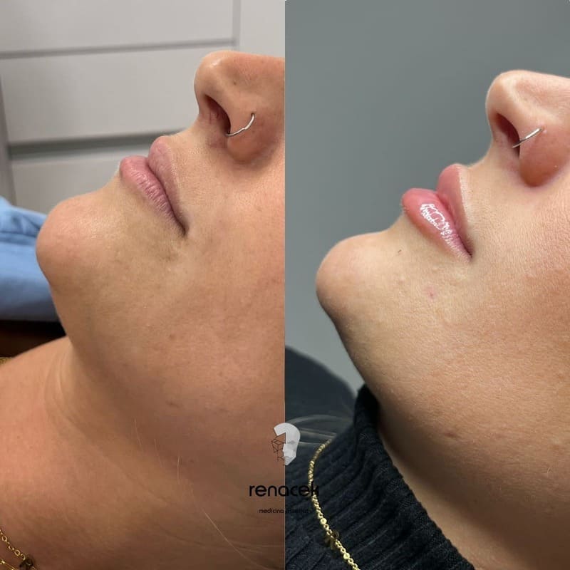 relleno de labios antes y después barcelona