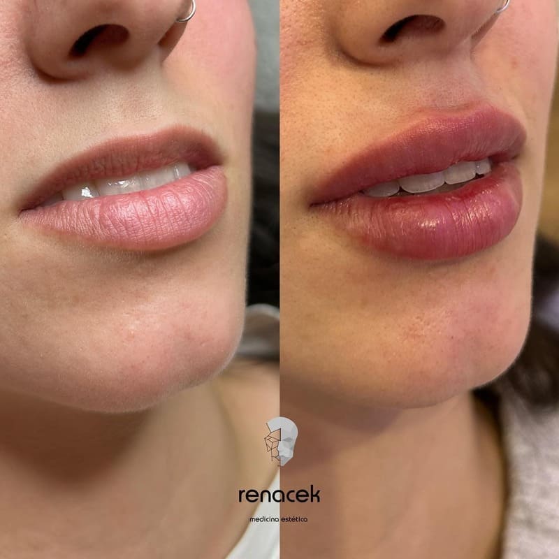 relleno de labios antes y después barcelona