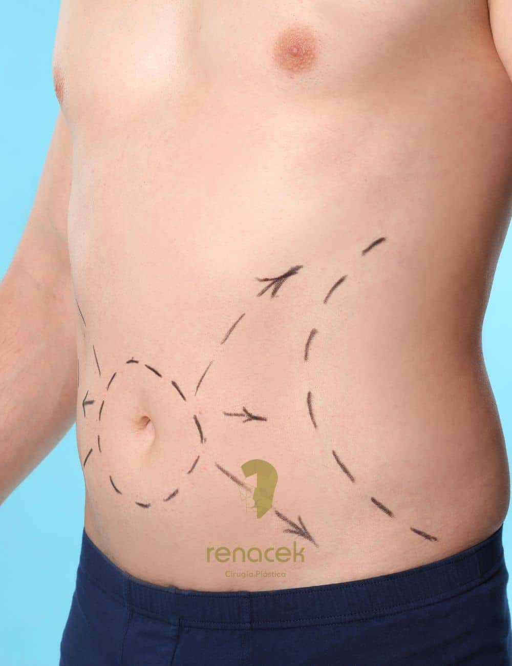 Abdominoplastia barcelona Precio